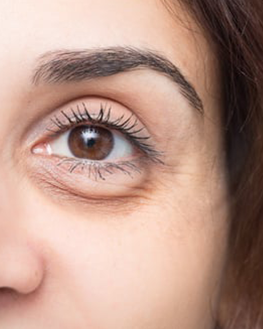 Bright Eye Treatment