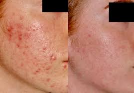 The Medical Acne Facial